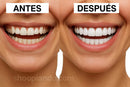 Belleza Carillas Dentales Removibles – Sonríe con Confianza al Instante de Tendeli- Ecuador en